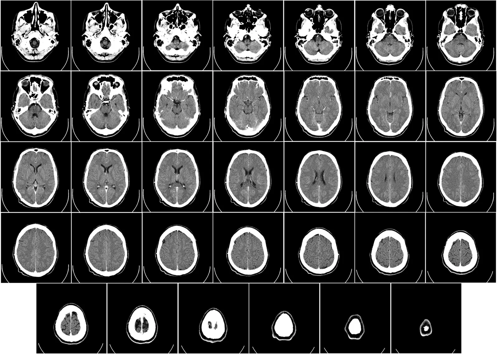 A computed tomography (CT) scan of a human brain